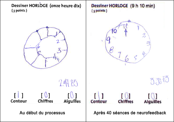 demence-alzheimer-figure2