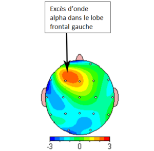 anxiete-depression-neuroperforma-1
