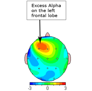 anxiete-depression-neuroperforma-en